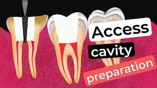 Access cavity preparation  How to prevent errors