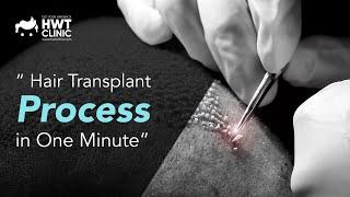 Sapphire Fue Hair Transplant Operation Process in One Minute at HWT CLINIC