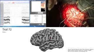 Mapping language ability during awake brain surgery