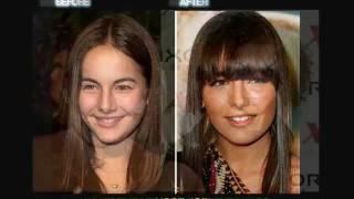 Celebrity Plastic Surgery before and after