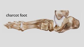 Charcot Foot