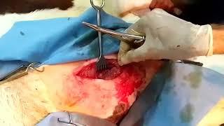 Treatment of spastic paresis in calf by cutting tibial nerve