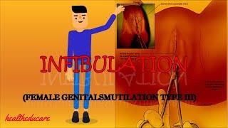 INFIBULATION FEMALE GENITAL MUTILATION TYPE III