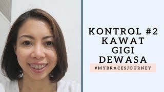 Kontrol #2 - Kawat Gigi Dewasa #MyBracesJourney  irene ijoli