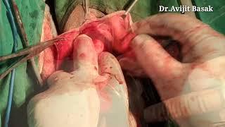 Vaginal Hysterectomy with PFR by Dr.Avijit Basak