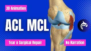 ACL Anterior Cruciate Ligament MCL Medial Collateral Ligament Tear and Repair No Narration