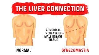 What is Gynecomastia Man Boobs? - Dr.Berg on Liver