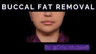 BUCCAL FAT PAD REMOVAL by @DrScottsdale