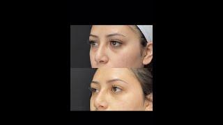 Under Eye Filler Treatment with PA Cathy - Ageless MD