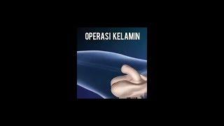 Cara Operasi Kelamin