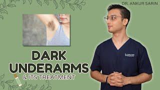 Dark Underarm Treatment  Dark Underarms Whitening  Acanthosis Nigricans  Dr. Ankur Sarin