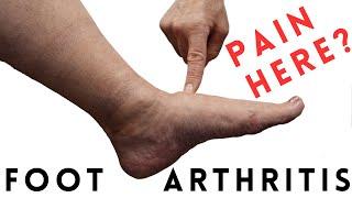 Foot Arthritis Pain Most Common Signs and Symptoms