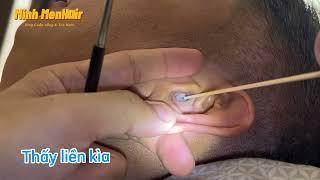 Một xíu khô cứng với anh trai - asmr-Earwax- lấy ráy tai  Minh MenHair