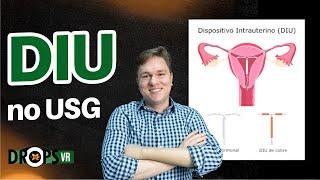 APRENDA A VERIFICAR O POSICIONAMENTO DO DIU NA USG I VOCÊ RADIOLOGISTA