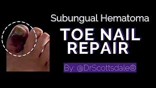 Subungual Hematoma Toe Nail Repair by @DrScottsdale 