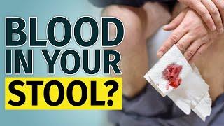 BLOOD IN STOOL  Other Signs You Have to Check