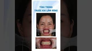 Mang về nụ cười mơ ước trong nháy mắt   #feedback#veneers#rangsu#smileht#nhakhoasmileht#nucuoitutin