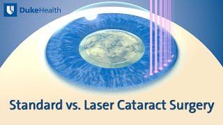 Standard vs. Laser Cataract Surgery  Duke Health