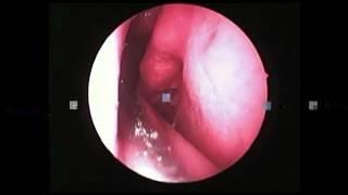 ENDOSCOPIC SPHENOETHMOIDECTOMY