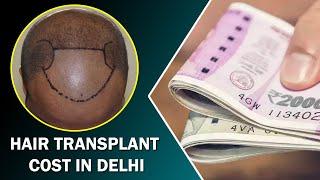 Hair Transplant Cost in Delhi India  FUE FUT  Hair Restoration Cost in Delhi  Dr. PK Talwar