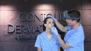 Dr. Timothy Jochen demonstrates Lip Enhancement with Perlane