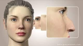 Ринопластика Операция на носу Анимационное видео - доктор Гунцель Озтурк