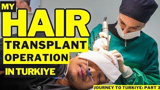 I Went To Turkiye For A Hair Transplant Expecting PAIN...FULL Operation Video