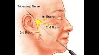 Trigeminal Neuralgia