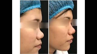 Algeness Organic Filler Demo by Dr Sutina   Enhanze Clinic 