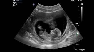 Advanced Early Pregnancy Scan 12-19 weeks