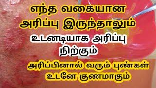 #Arrippumarundhu#Arrippumarundhu in Tamil#aripukkumarundhu#arippu#psoriasis homeremedy