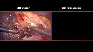 Asvide The Video One of 3D laparoscopic right posterior sectionectomy guided by 2D real-time ICG…