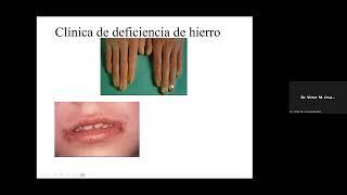 Anemia por Deficiencia de Hierro - Dr. Víctor A. Cruz Hernández
