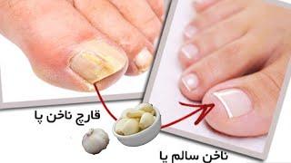 How to treat nail fungusif you suffer from your nail fungus you must try this درمان  قارچ ناخون#