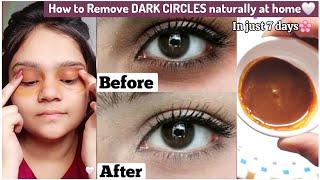 How to Remove DARK CIRCLES Naturally In Just 7 days works  Get Rid of Dark Circles At Home