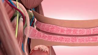 Peyronies Disease treatment Animation Steinberg Urology Montreal