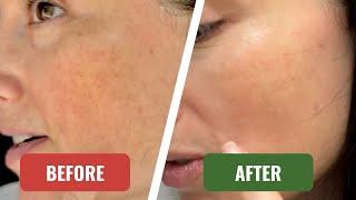 7 day results on Turmeric and Kojic acid cleansing pads