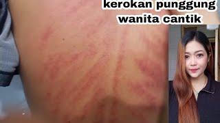 Kerokan punggung wanita terbaru  Pertolongan pertama masuk angin obat tradisional