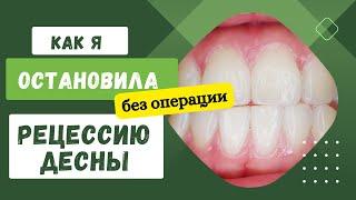 Как я остановила рецессию десны без операции. 4 минуты в день и десны стали возвращаться на место