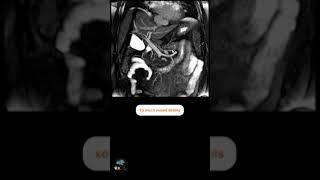 MRI non CONTRAST ENHANCED ABDOMEN