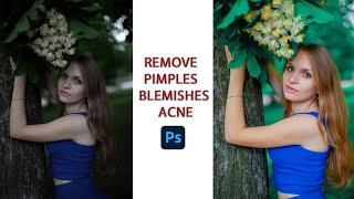 Remove  pimples  Blemishes Acne Scars Easily and Quickly Photoshop Tutorial   Vidu Art