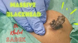 Massive 15 year Blackhead. Dr Khaled Sadek. LipomaCyst.com