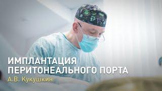 Имплантация перитонеального порта. Видео из операционной оперирует Андрей Всеволодович Кукушкин.