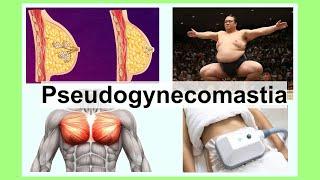 pseudogynecomastia