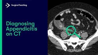 Diagnosing Appendicitis on CT