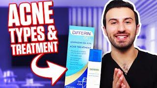 How to take care of your Acne  Dr. Tomassian