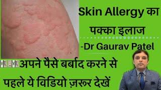 स्किन ऐलर्जी का इलाज।Skin Allergy Treatment At Home By Dermatologist Dr Gaurav Patel #skinallergy