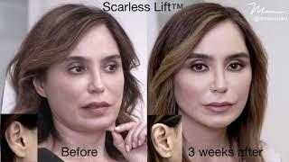 Scarless Lift™️ by Dr. Marc Mani