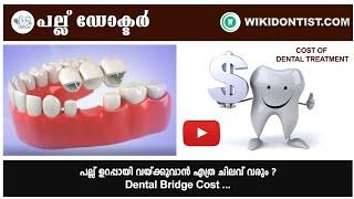 പല്ല് ഉറപ്പായി വയ്ക്കുവാൻ എത്ര ചിലവ് വരും Dental Bridge CostPart - 1Video by Dr.Thomas Nechupadam