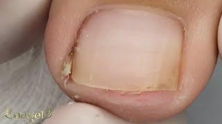 SAIBA COMO PREVENIR UMA UNHA ENCRAVADA #satisfying #ingrowntoenail